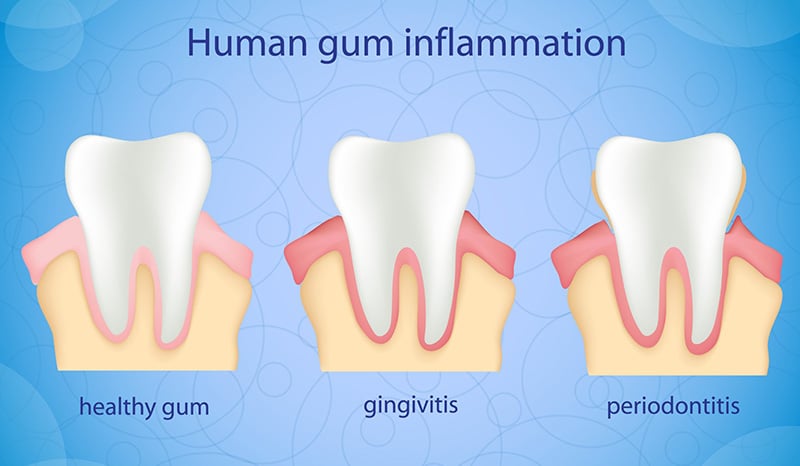 A medical illustration showing the different stages of human gum inflammation