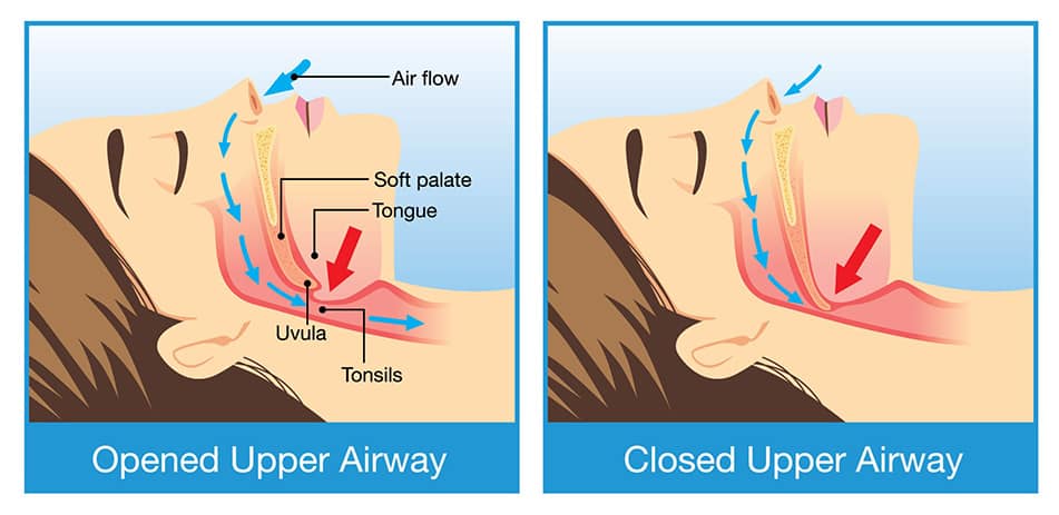 A medical illustration comparing an open and closed airway