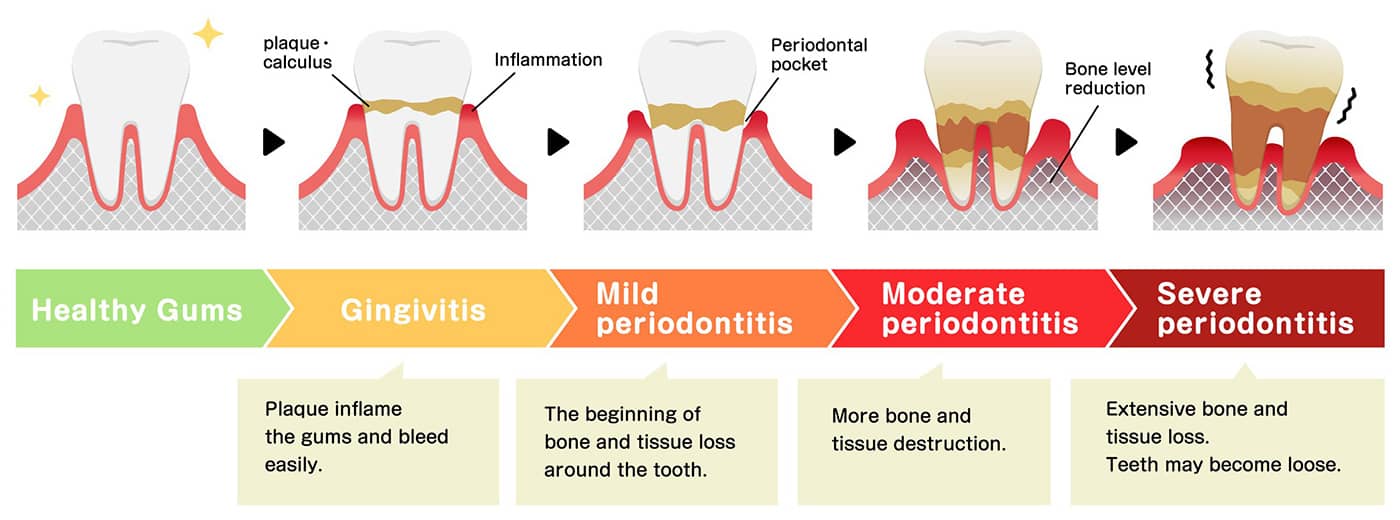 An illustration showing how the stages of periodontal disease development affects teeth