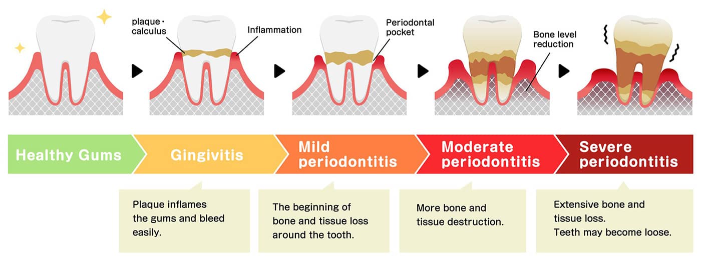 A diagram showing the stages of dental cavities